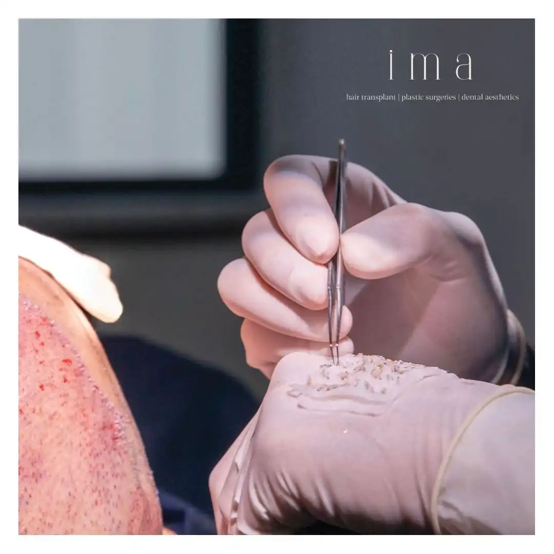 Saç Ekimi Sonrası Kabuklanma Ne Zaman Geçer?